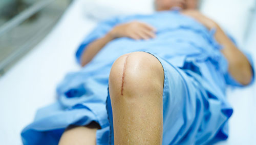 Conventional vs Robotic Joint Replacement