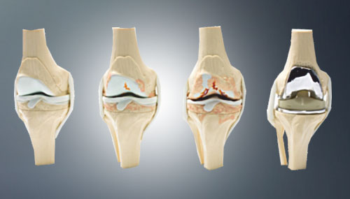 Knee Replacement Surgery Details